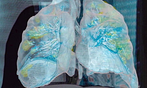 ¿Cómo mata el coronavirus? Los médicos rastrean un alboroto feroz a través del cuerpo, desde el cerebro hasta los dedos de los pies